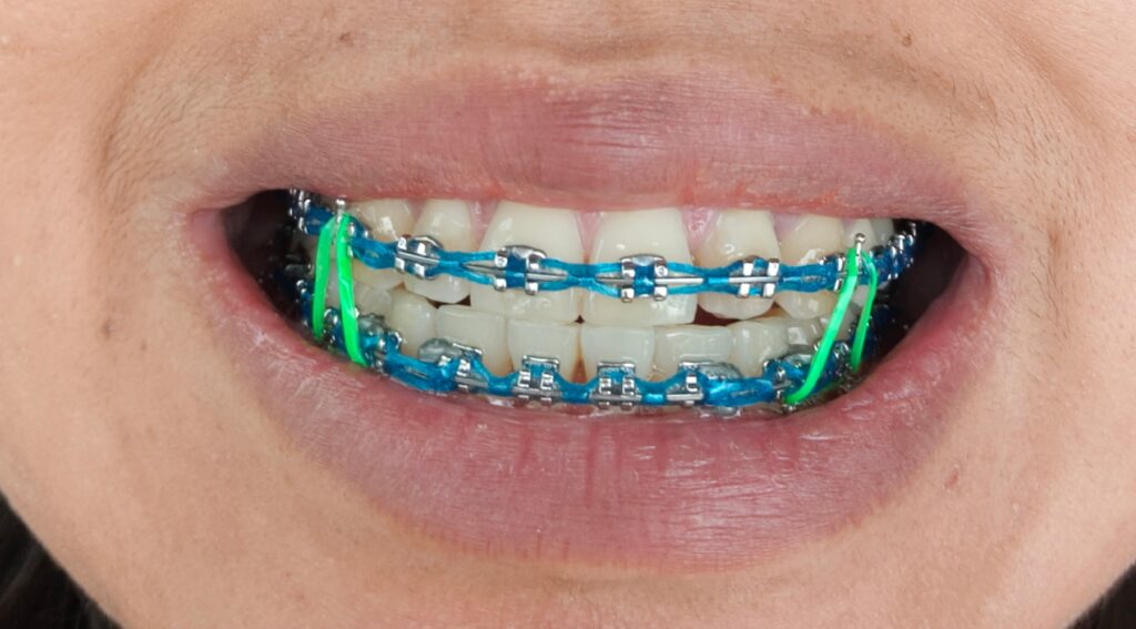 Comparing Colors for Braces: Which Is the Best Choice for You?
