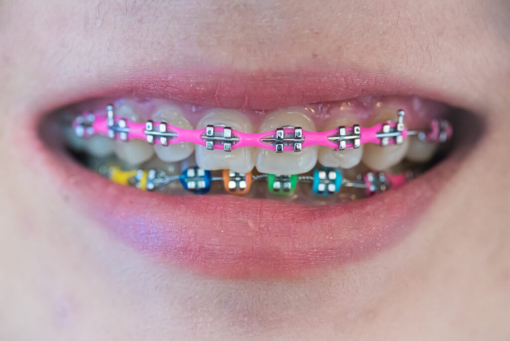 Comparing Colors for Braces: Which Is the Best Choice for You?