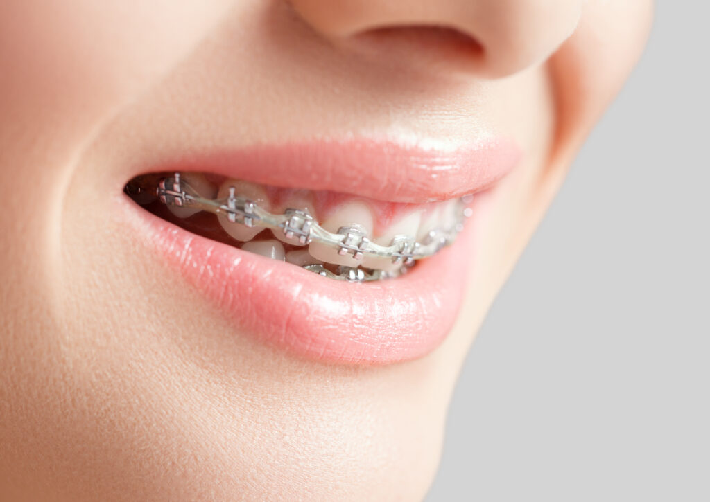 Comparing Colors for Braces: Which Is the Best Choice for You?